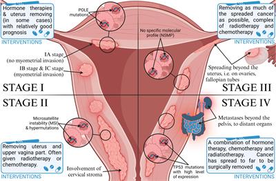 The role of ncRNAs and exosomes in the development and progression of endometrial cancer